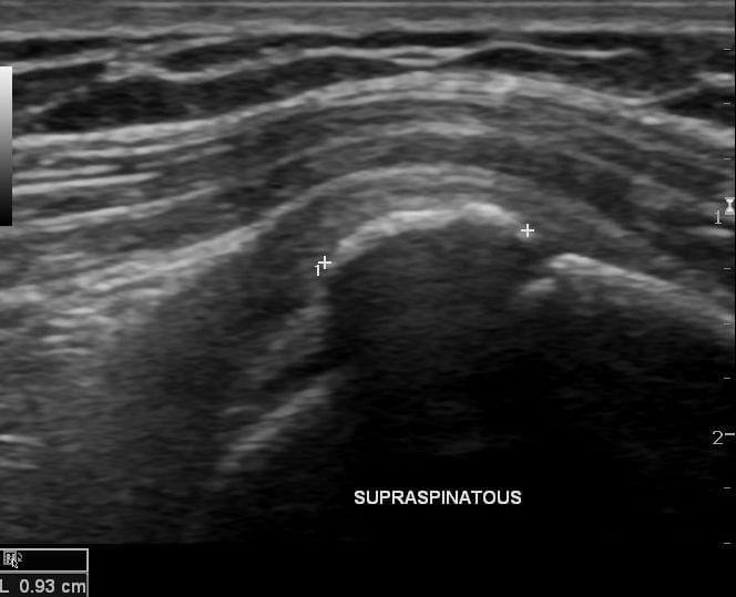 Ultrasound of the supraspinatus tendon demonstrating a Type 1 (formative phase) calcific deposit within the tendon.
