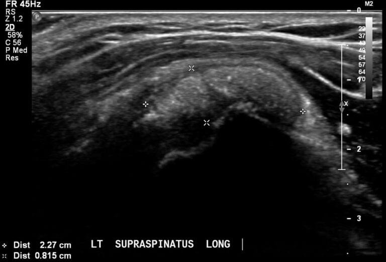 Ultrasound of the supraspinatus tendon demonstrating a Type 3 (resorptive phase) calcific deposit with features consistent with active resorption.