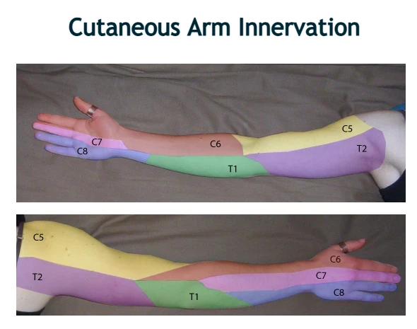 Dermatomal distribution of cervical nerve roots showing sensory innervation of the shoulder, arm, and hand.