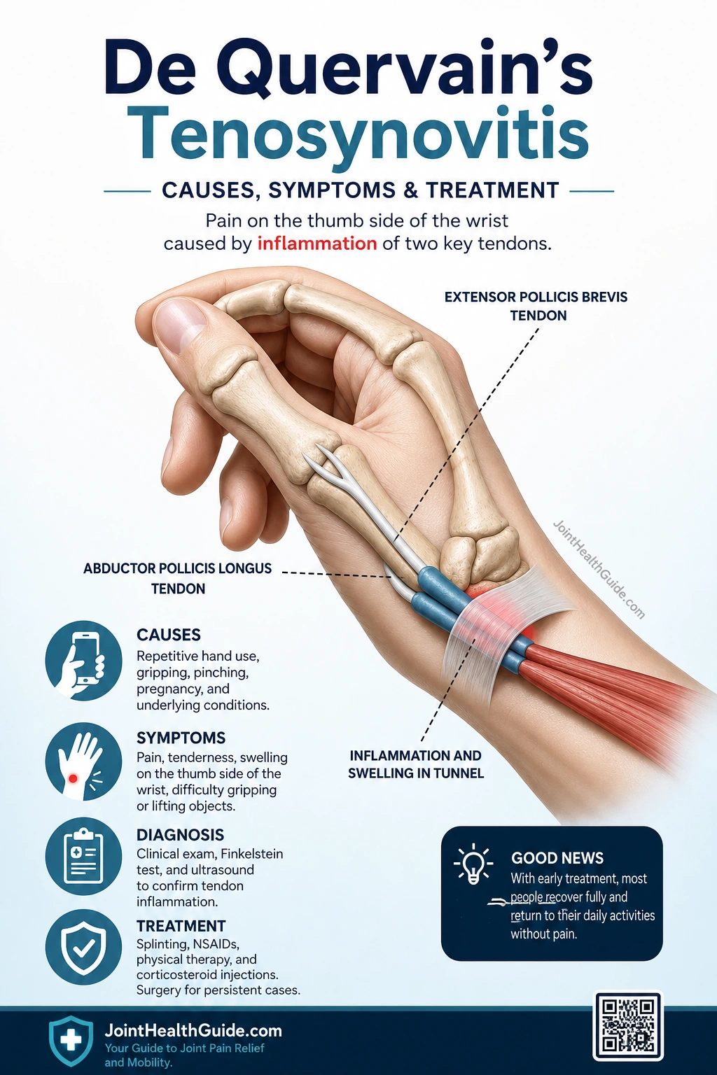 Infographic explaining De Quervain tenosynovitis, highlighting inflammation of the first dorsal compartment at the wrist beneath the extensor retinaculum, involving the abductor pollicis longus and extensor pollicis brevis tendons, with visual emphasis on pain location, tendon friction, and reduced thumb mobility.