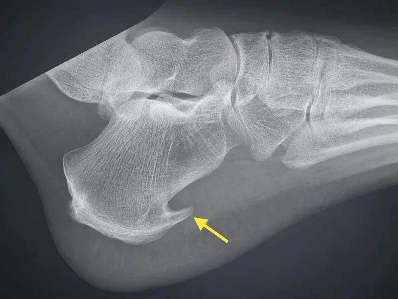X‑ray image showing a plantar calcaneal spur (heel spur) on the underside of the heel bone.