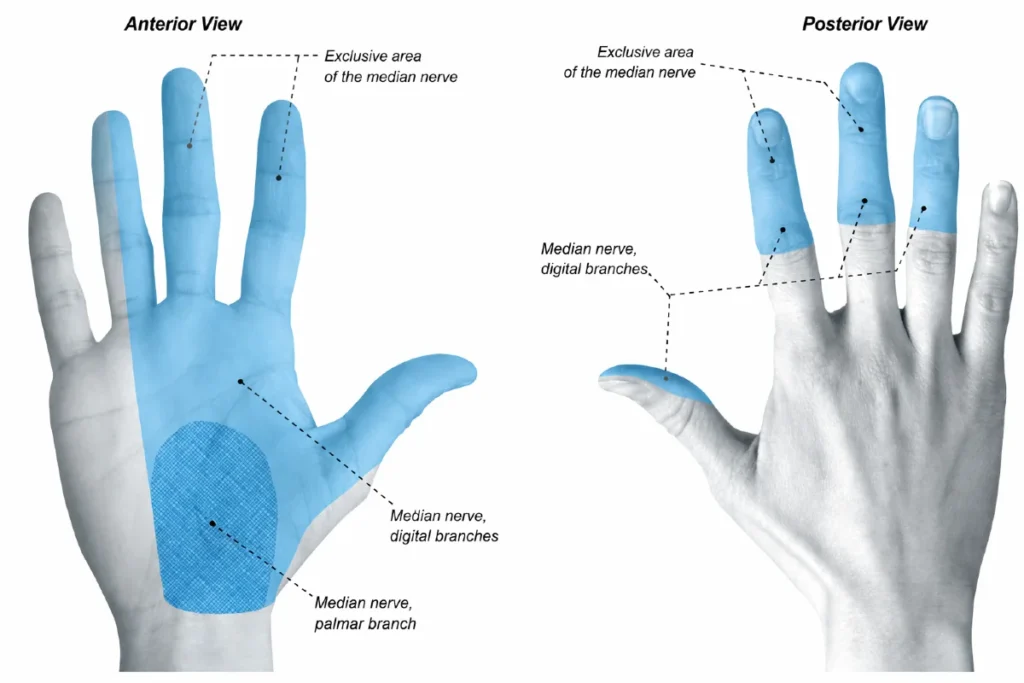 Sensory distribution of the median nerve highlighted in red, showing areas of hypoesthesia in carpal tunnel syndrome.