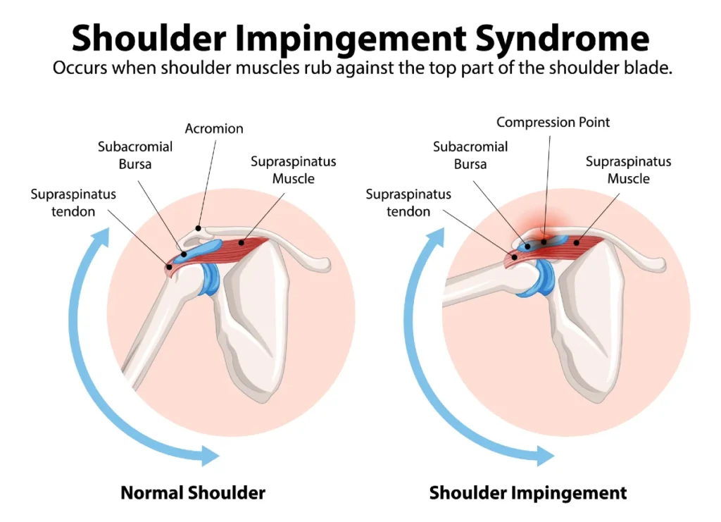 Medical schematic of shoulder impingement syndrome depicting narrowing of the subacromial space where the rotator cuff tendons are compressed between the acromion and the humerus when the arm is raised.