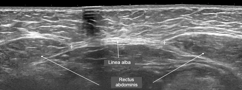 Ultrasound image showing diastasis recti with separated rectus abdominis muscles and widened linea alba in the middle of the abdomen