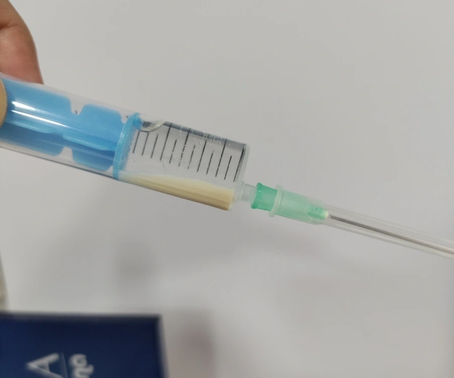 Calcium deposits aspirated during ultrasound-guided barbotage for calcific tendonitis, visible as white calcium sediment inside a syringe.