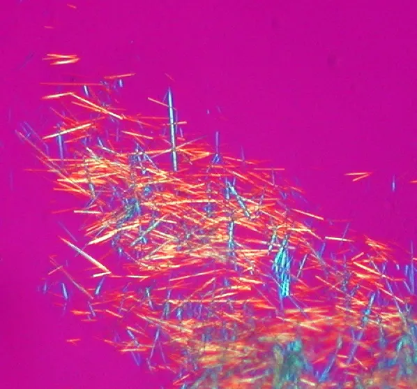 Monosodium urate crystals under polarized light microscopy in gout