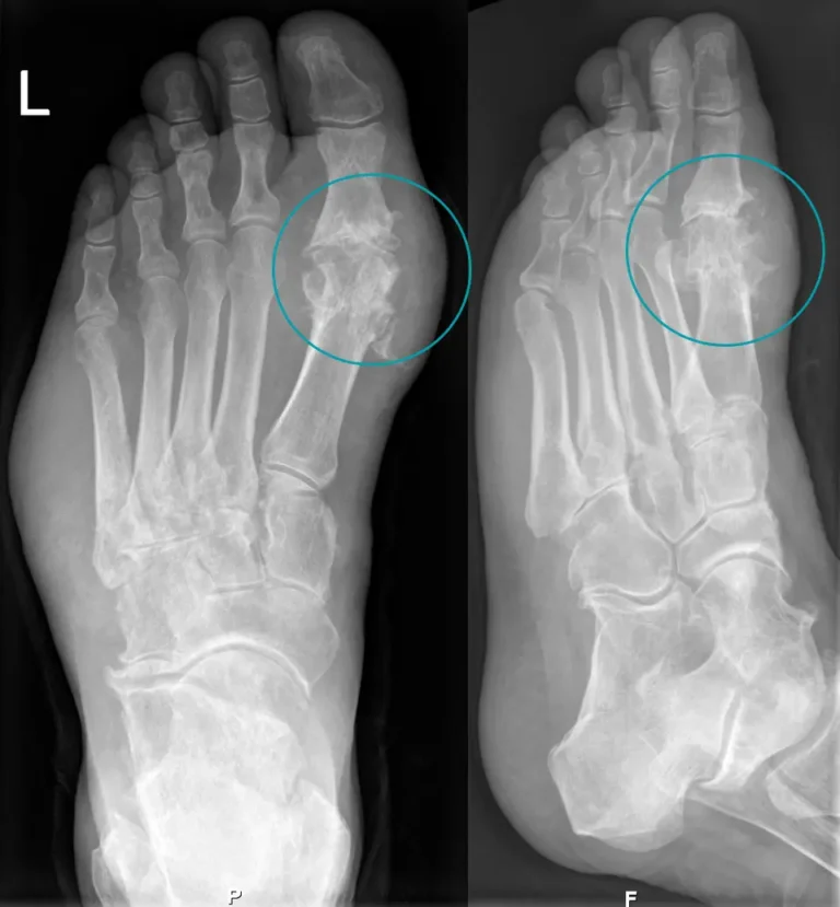 Foot X-ray showing chronic gout with permanent joint damage of the big toe