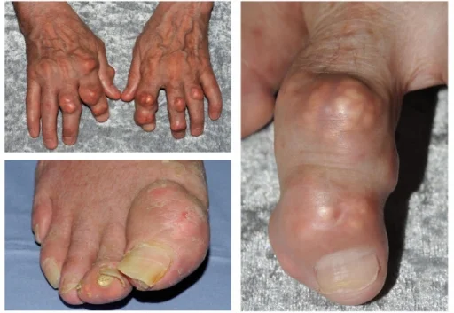 Chronic tophaceous gout with visible tophi and joint deformities of the hands and feet
