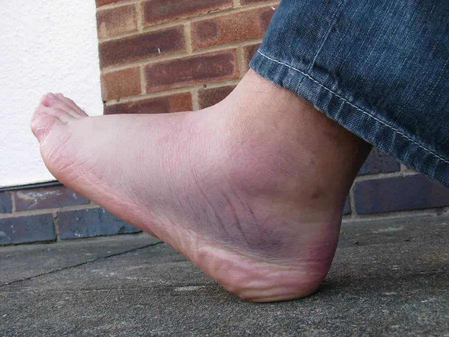 Sprained ankle with swelling and bruising around the outer ankle