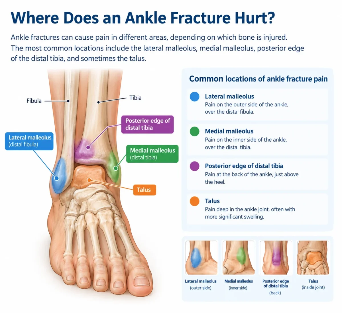 Ankle fracture pain locations including the lateral malleolus, medial malleolus, distal tibia, and talus.