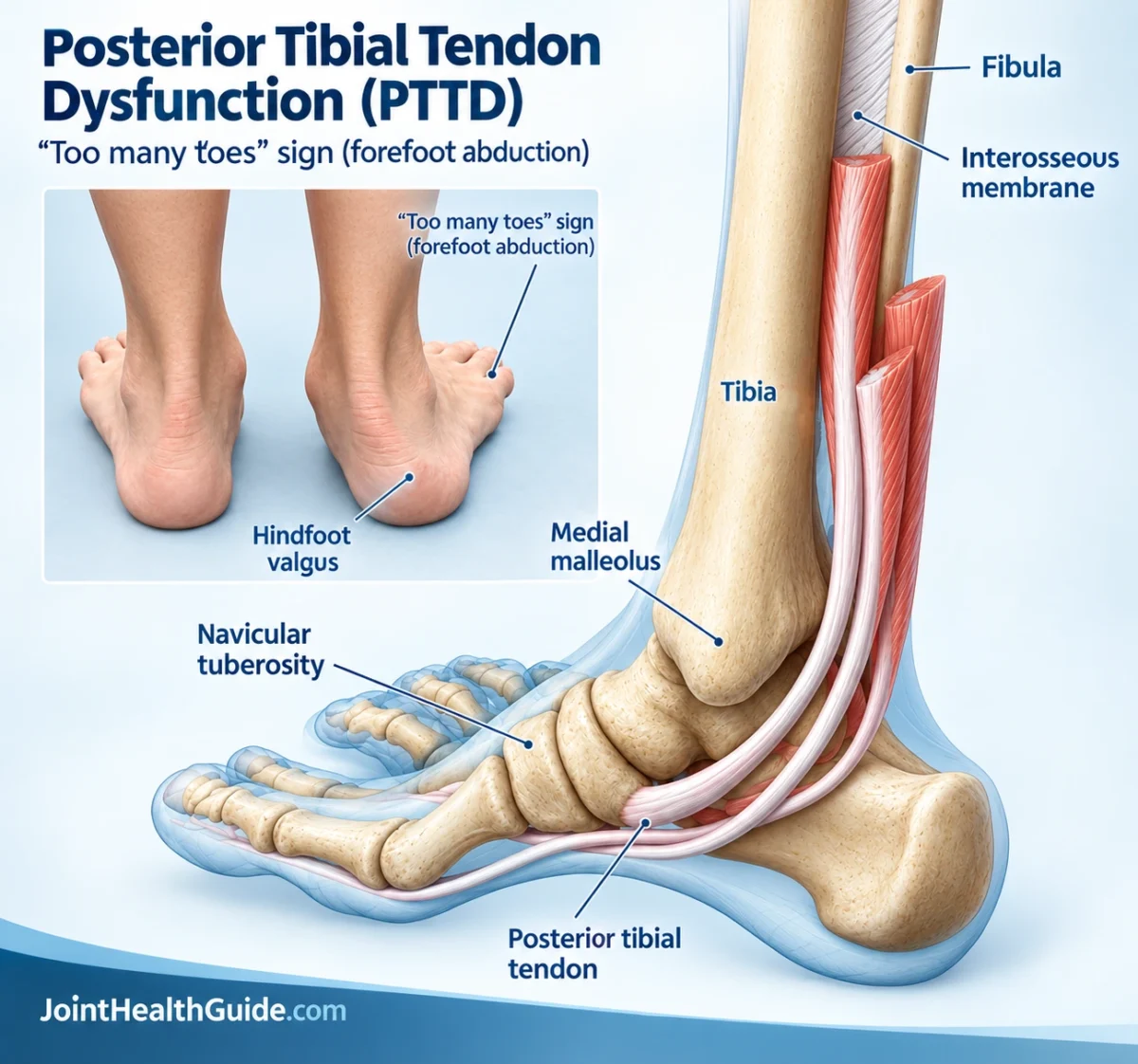 Posterior tibial tendon running behind the medial malleolus and supporting the arch of the foot.